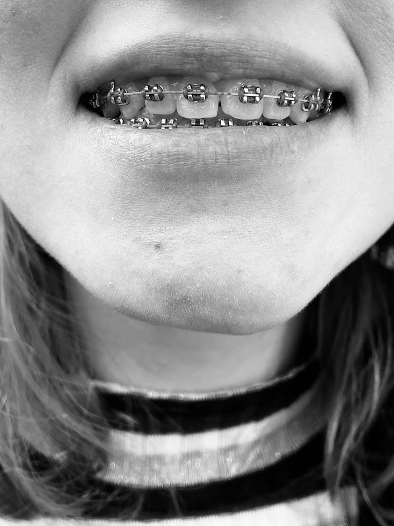 Close-up black and white photo showing a smile with metal braces on teeth.